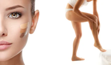 Exemple de camouflage cosmétique d’une zone de vitiligo